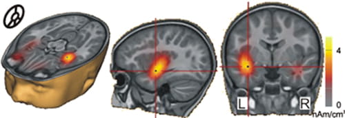 Brain activity in auditory cortex